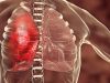 Augmentation des infections pulmonaires : quels sont les facteurs en cause ?