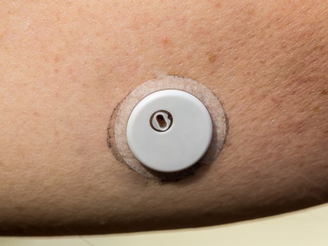 Un capteur de glucose FreeStyle Libre 3 posé sur le bras (photo d'illustration) Un capteur de glucose FreeStyle Libre 3 posé sur le bras (photo d'illustration)